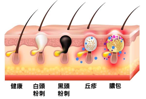 一年四季都有可能出現粉刺面皰