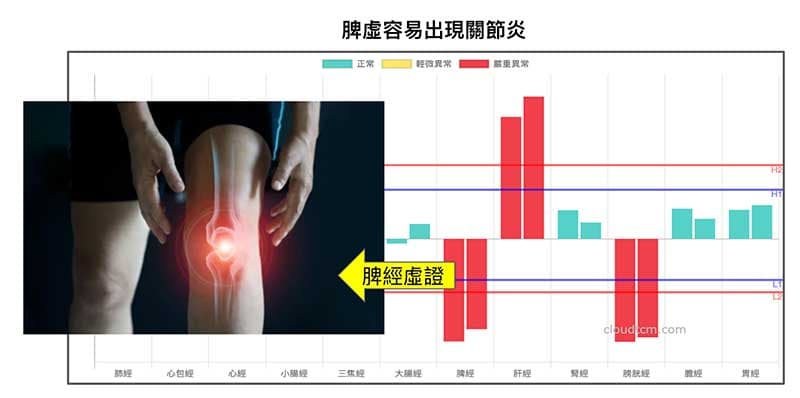 鐵三角經絡型態，最容易出現關節炎