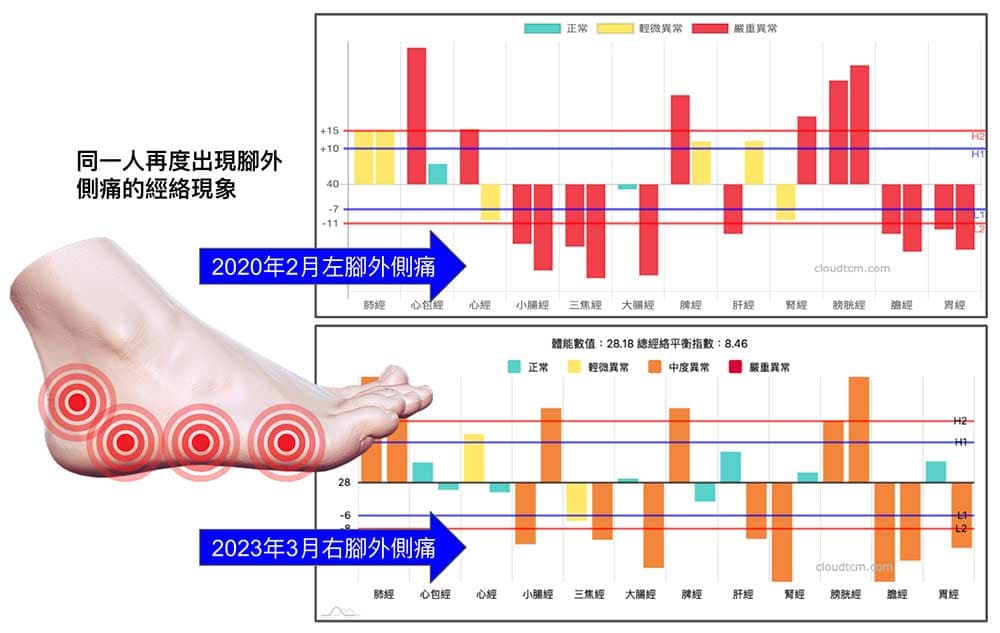 左右腳外側痛復發，經絡型態幾乎一樣