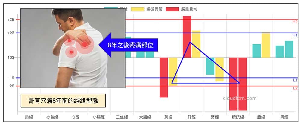 鐵三角經絡現象與膏肓穴痛