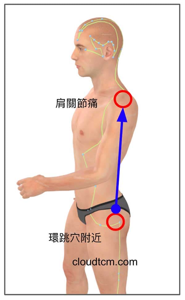膽經異常也會造成肩關節痛