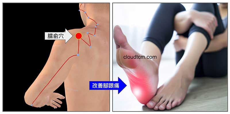 針刺臑俞穴，竟然可以改善腳跟痛