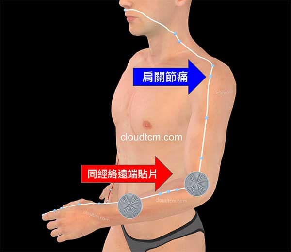 在經絡的遠端貼電療貼片