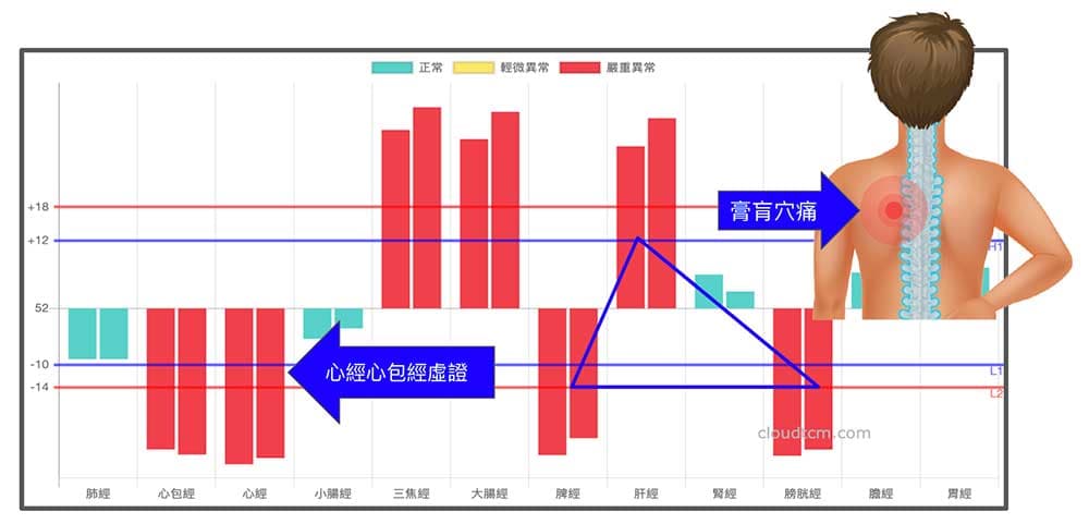 鐵三角經絡變化與膏肓穴痛