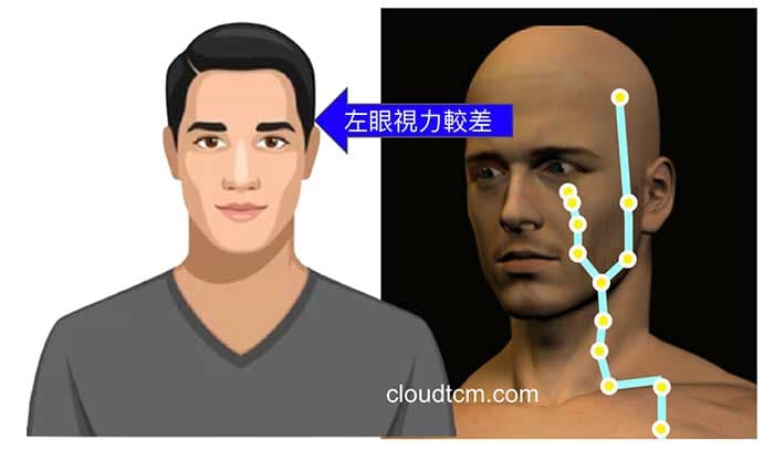 陽明經差異，左眼近視度數較高
