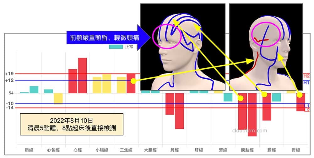 熬夜嚴重睡眠不足，前額頭昏頭痛的經絡現象