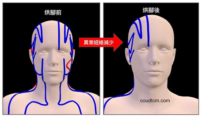 烘腳之後通往頭部的異常經絡大幅減少