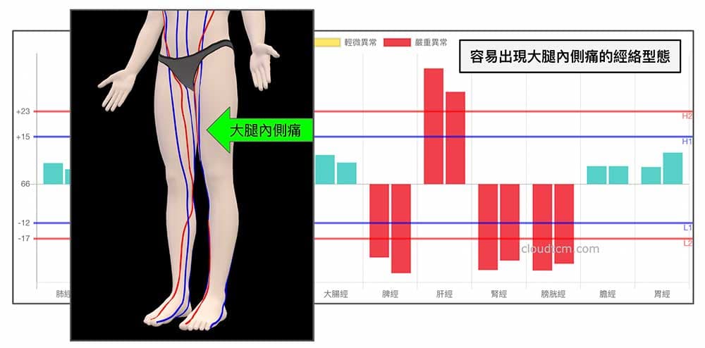 容易出現大腿內側痛的鐵三角經絡型態