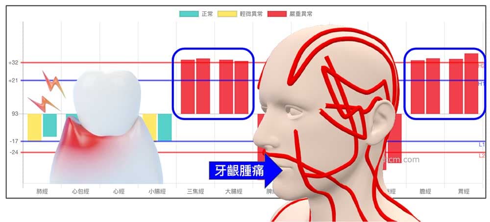 陽明經與少陽經實證時,容易出現牙齦腫痛