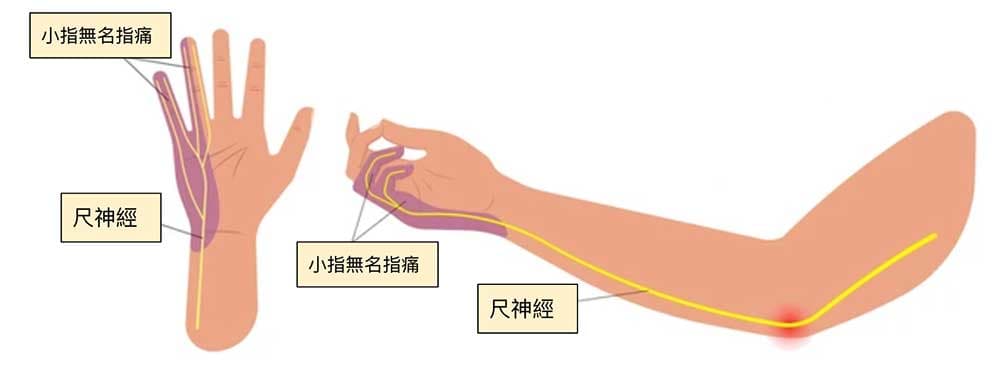 尺神經影響到整個前臂與小指無名指