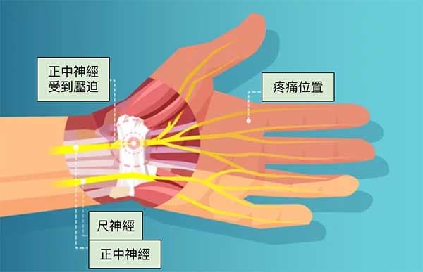 正中神經受到壓迫影響食指、中指大拇指