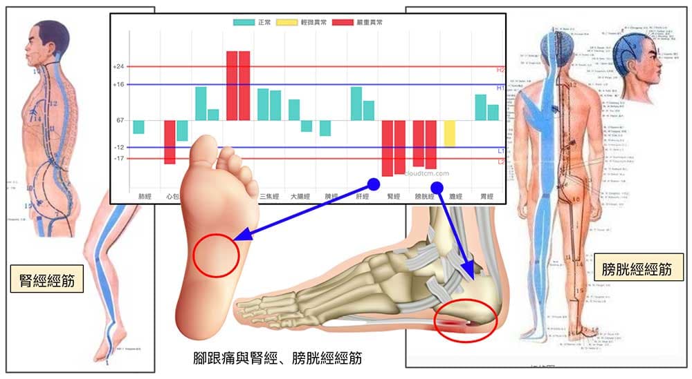 膀胱經與腎經的經筋病變，容易造成腳跟痛