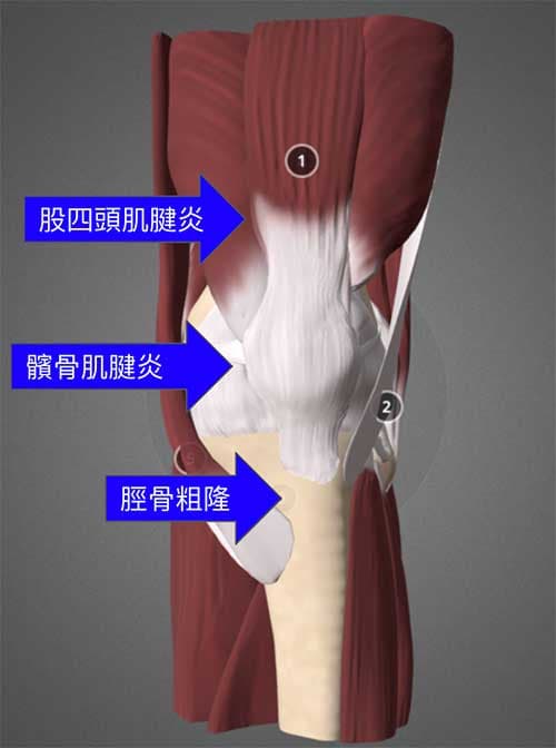 膝蓋上緣與前側的疼痛原因