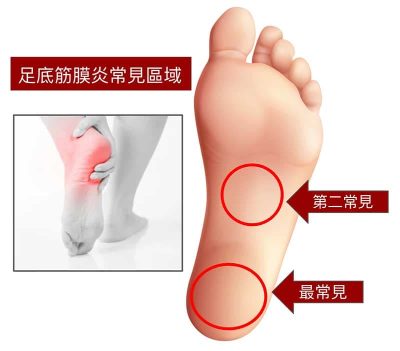 足底筋膜炎常見的兩個位置