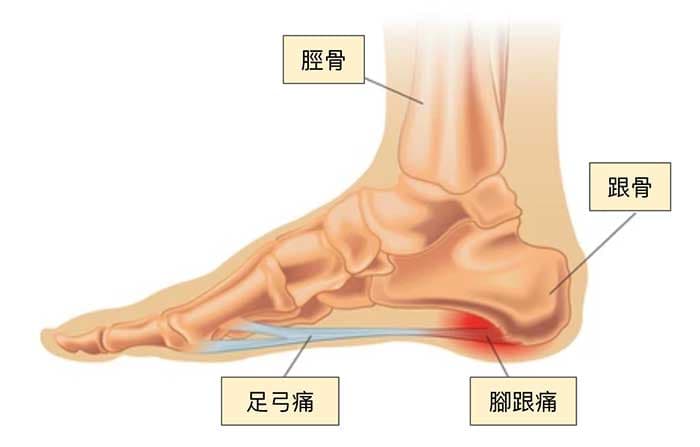 足底筋膜異常時，容易出現的腳跟與足弓痛