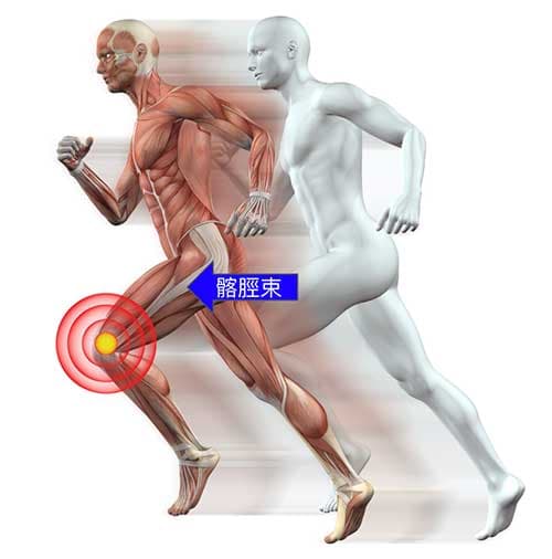 經常跑步的人容易膝蓋外側痛