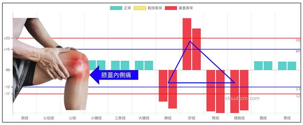 鐵三角經絡型態，最容易出現膝蓋內側痛