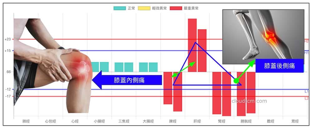 鐵三角經絡型態變化型，容易出現膝蓋內側、後側痛