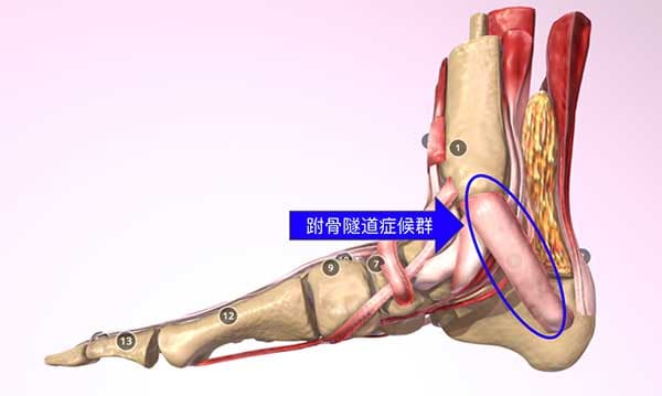 跗骨隧道症候群,經常出現腳踝內側痛