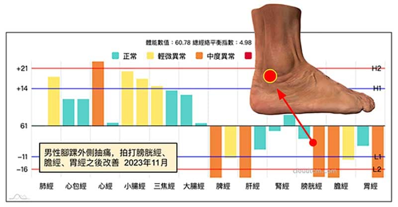 2023年11月之後出現腳踝外側痛