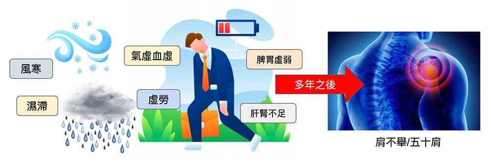 從中醫經絡立場看五十肩,要累積很久的時間才有可能形成