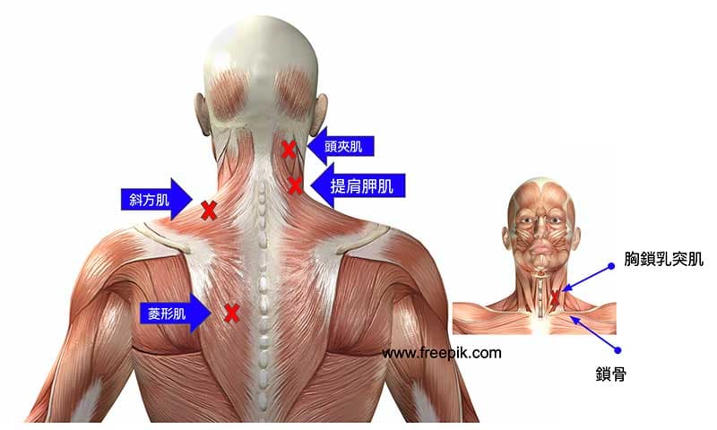 肩頸痛，只要在這些肌肉上找出激痛點揉開沾粘即可