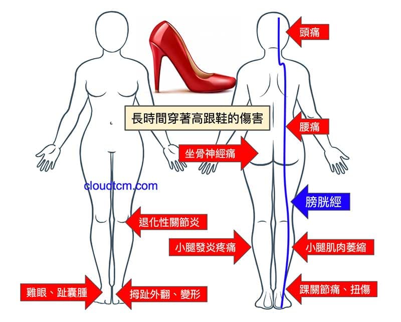 長期穿高跟鞋對女性帶來許多身體的傷害