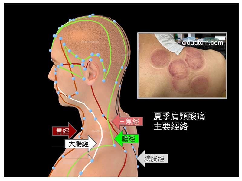 進入夏季之後的肩頸酸痛容易緩解