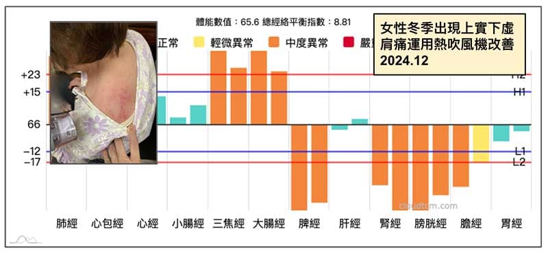 女性肩痛運用熱吹風機改善