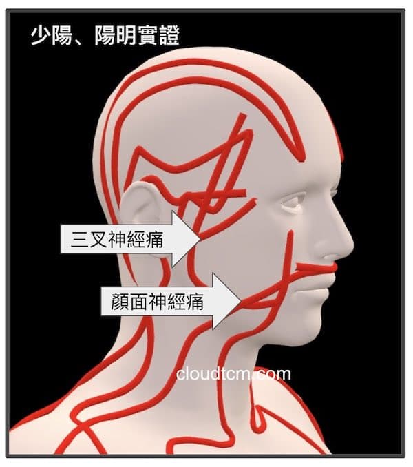 當少陽經、陽明經實證時,出現顏面神經痛