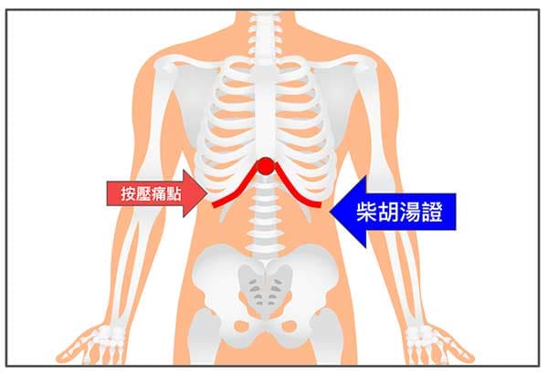 按壓胸骨劍突,肋骨附近疼痛是柴湖湯證