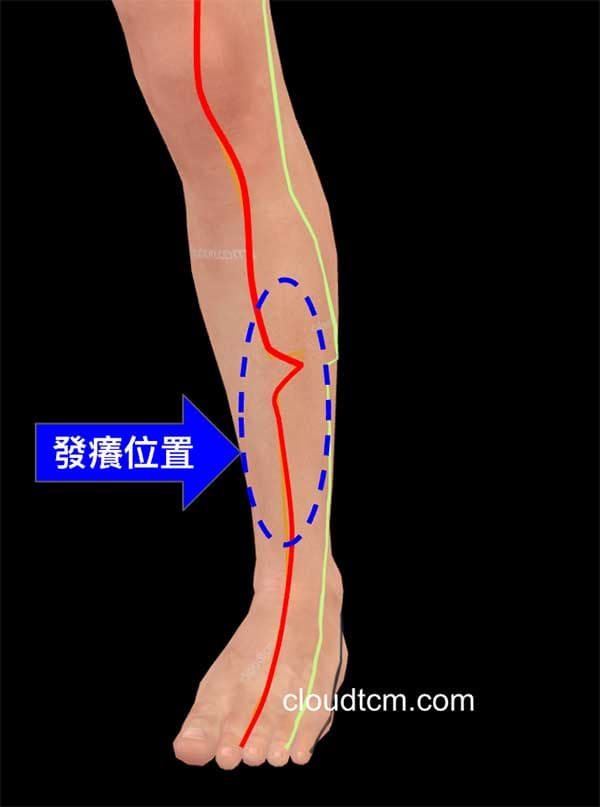 烘腳後發癢位置在胃經上