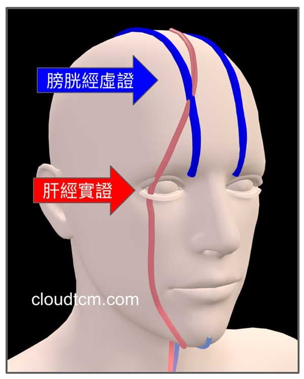 夏季的特殊經絡現象,很容易出現頭痛