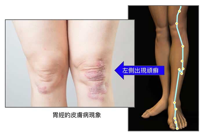 長期胃經異常所出現的左膝蓋頑癬