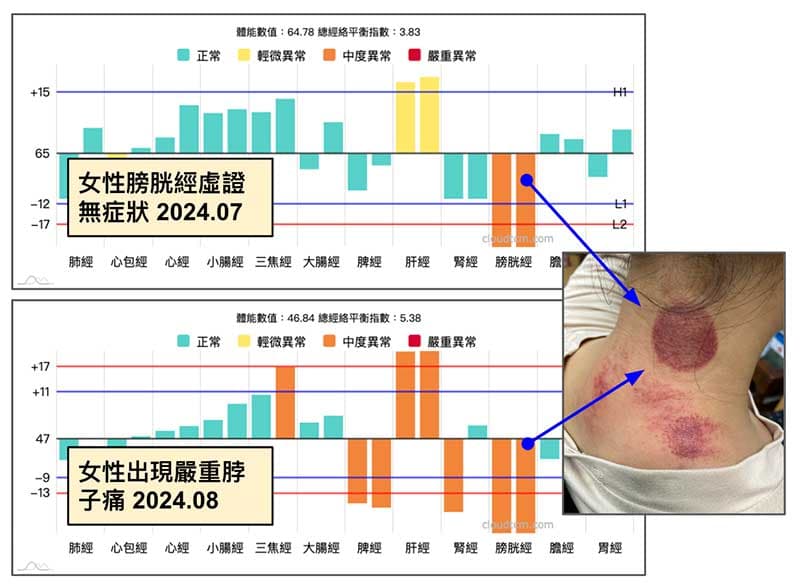 女性夏季出現膀胱經異常及相關疼痛案例