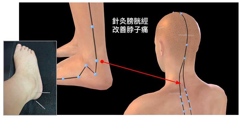 針灸腳部可以改善脖子痛真實案例