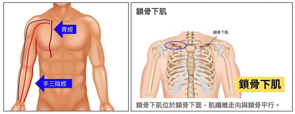 鎖骨下肌的肌肉沾粘，常常會造成肩頸酸痛