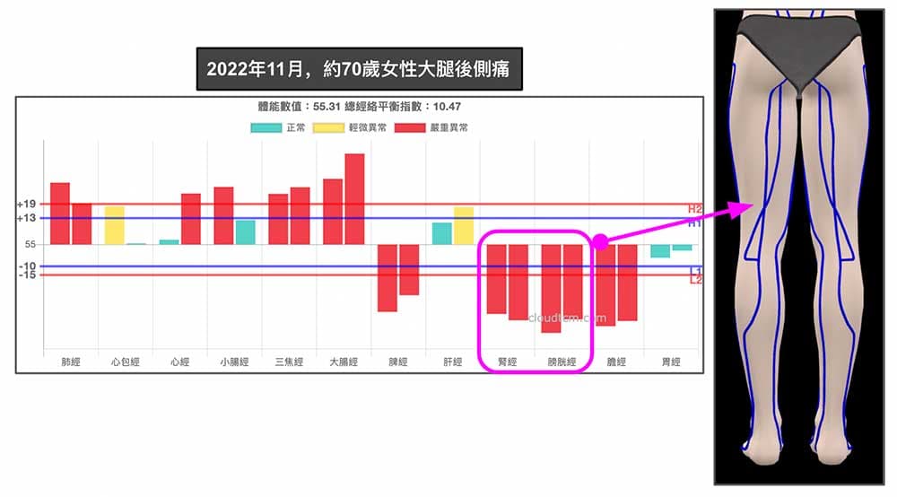 2022年11月,約70歲女性出現大腿後側痛