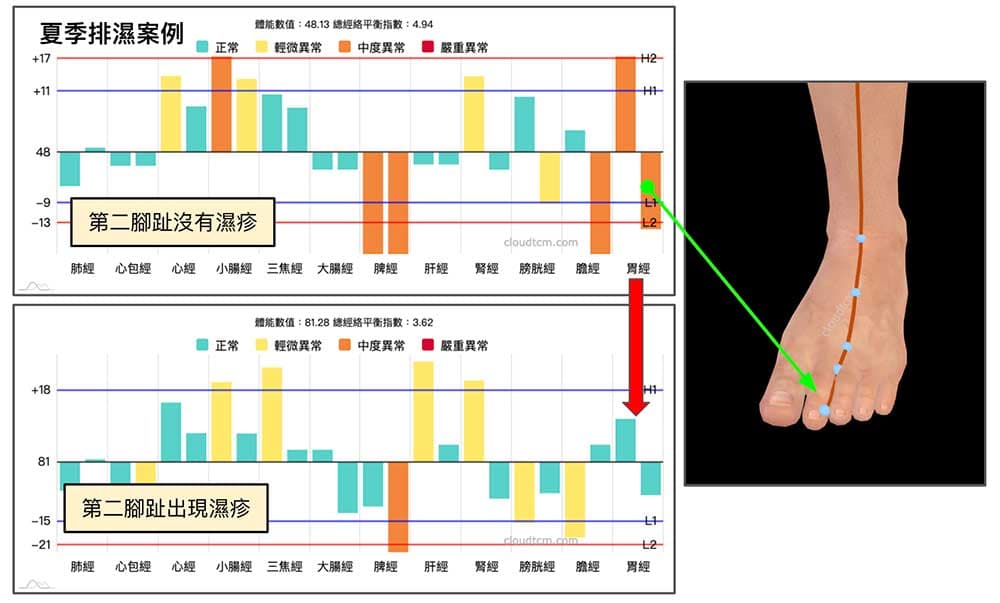夏季濕疹與胃經排濕現象