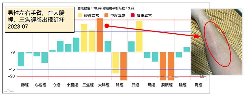 2023年夏季手臂紅疹出現在大腸經、三焦經上